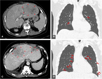 Case report: Predictability of clinical response and rejection risk after immune checkpoint inhibition in liver transplantation